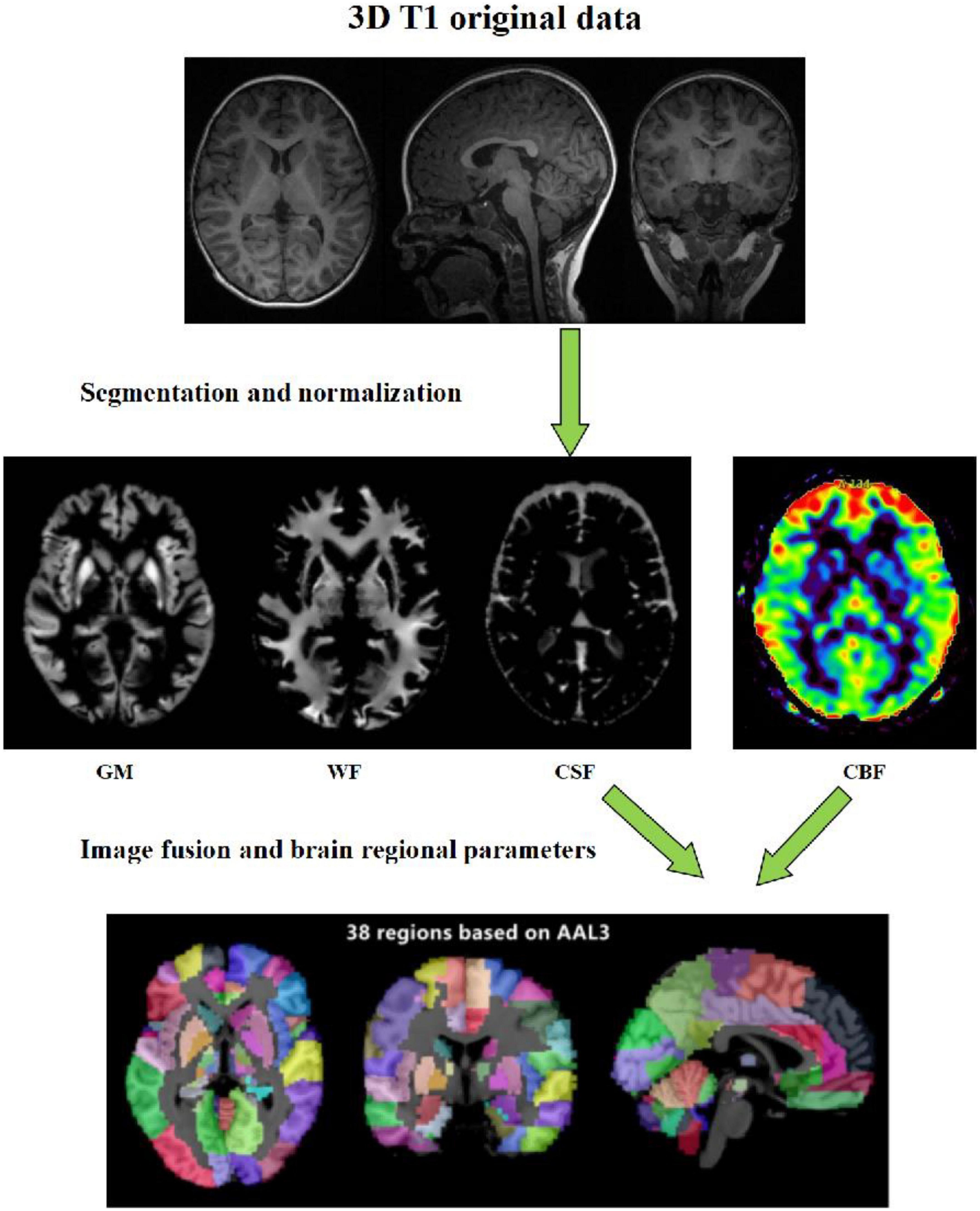 Three-dimensional pseudocontinuous arterial spin labeling perfusion imaging shows cerebral blood flow perfusion decline in attention-deficit/hyperactivity disorder children